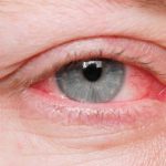 What Is Causing So Much Pink Eye?