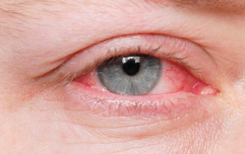 What Is Causing So Much Pink Eye?