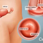 Cervical Cancer Screenings Double With Mailed Do-it-yourself Kits