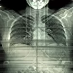 Operation Beats Focused Radiation for Early Stage Lung Most cancers