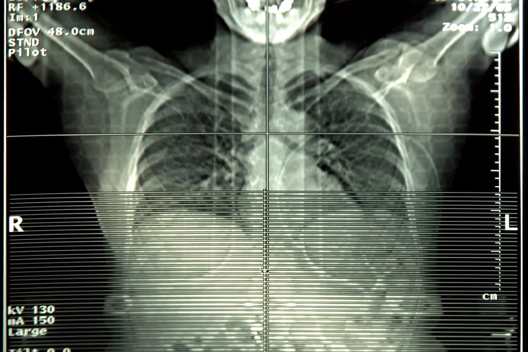 Operation Beats Focused Radiation for Early Stage Lung Most cancers
