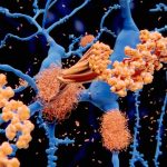 One more New Alzheimer’s Drug: What Promising Demo Success Imply for Procedure