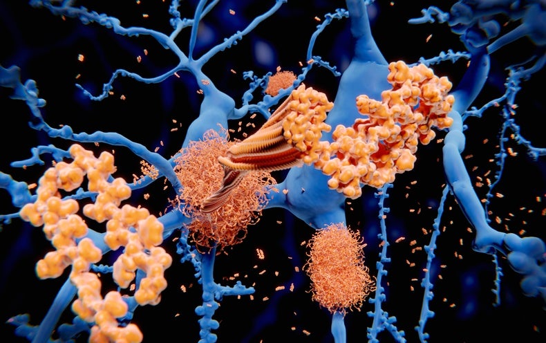 One more New Alzheimer’s Drug: What Promising Demo Success Imply for Procedure