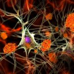 How 1 Man’s Unusual Alzheimer’s Mutation Delayed the Onset of Condition
