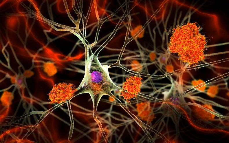 How 1 Man’s Unusual Alzheimer’s Mutation Delayed the Onset of Condition