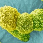 Pancreatic Most cancers Vaccine Reveals Assure in Compact Original Demo