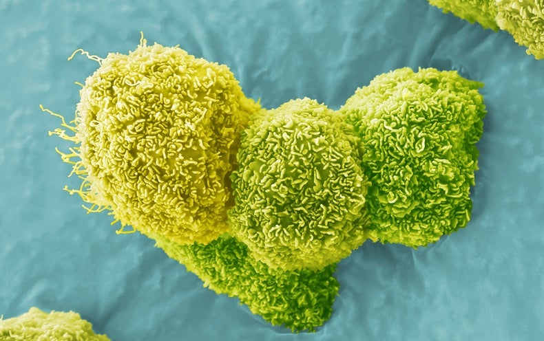 Pancreatic Most cancers Vaccine Reveals Assure in Compact Original Demo