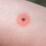 How to Shield Oneself from Ticks and the Dangerous Illnesses They Distribute
