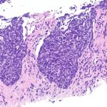 Lung Most cancers Capsule Halves Threat of Loss of life in Some Persons