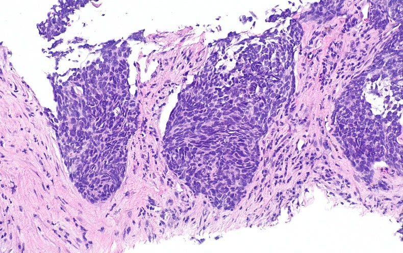 Lung Most cancers Capsule Halves Threat of Loss of life in Some Persons
