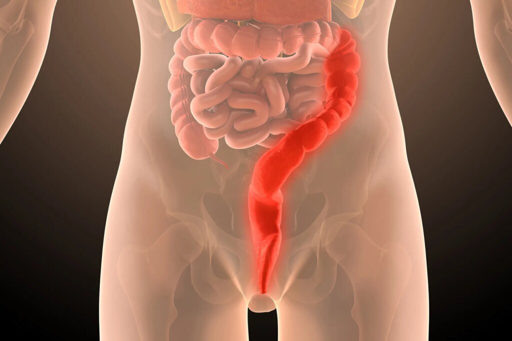 Actively playing As a result of the Discomfort of Ulcerative Colitis