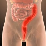 Actively playing As a result of the Discomfort of Ulcerative Colitis