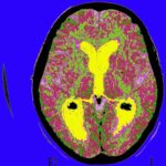 Alzheimer’s Drug Donanemab Assists Most When Taken Early in Condition