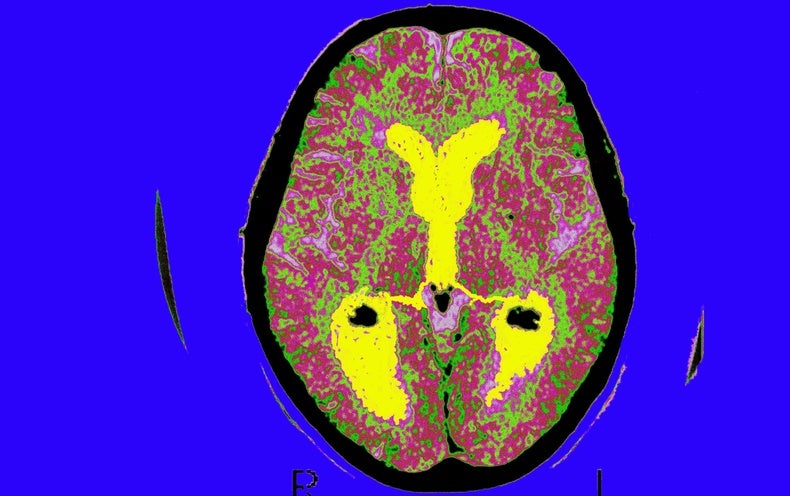 Alzheimer’s Drug Donanemab Assists Most When Taken Early in Condition