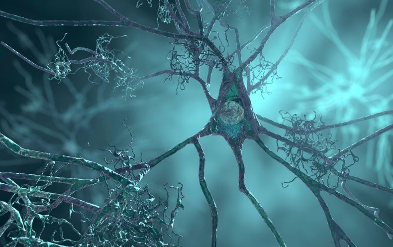 A Neurologist Responses Questions Individuals Could Have about the New Alzheimer’s Drug Lecanemab