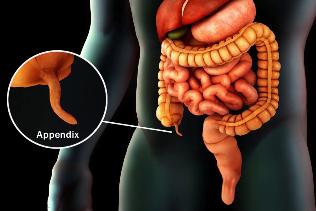 Little Organ, Very long-Long lasting Ache: Thriller of Chronic Appendicitis
