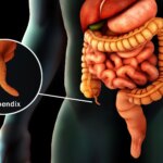 Little Organ, Very long-Long lasting Ache: Thriller of Chronic Appendicitis