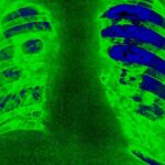 How Advocates Pushed Big Pharma to Lower Tuberculosis Drug Charges