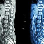 Newfound Stem Cell May well Describe How Breast Most cancers Spreads to the Spine