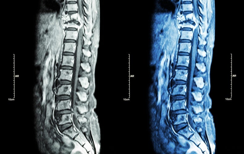 Newfound Stem Cell May well Describe How Breast Most cancers Spreads to the Spine