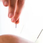 Extra Parents Turning to Acupuncture for Kids’ Soreness, Stress