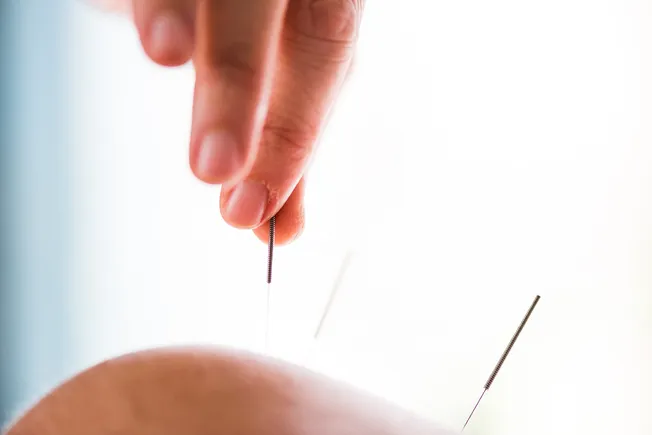 Extra Parents Turning to Acupuncture for Kids’ Soreness, Stress