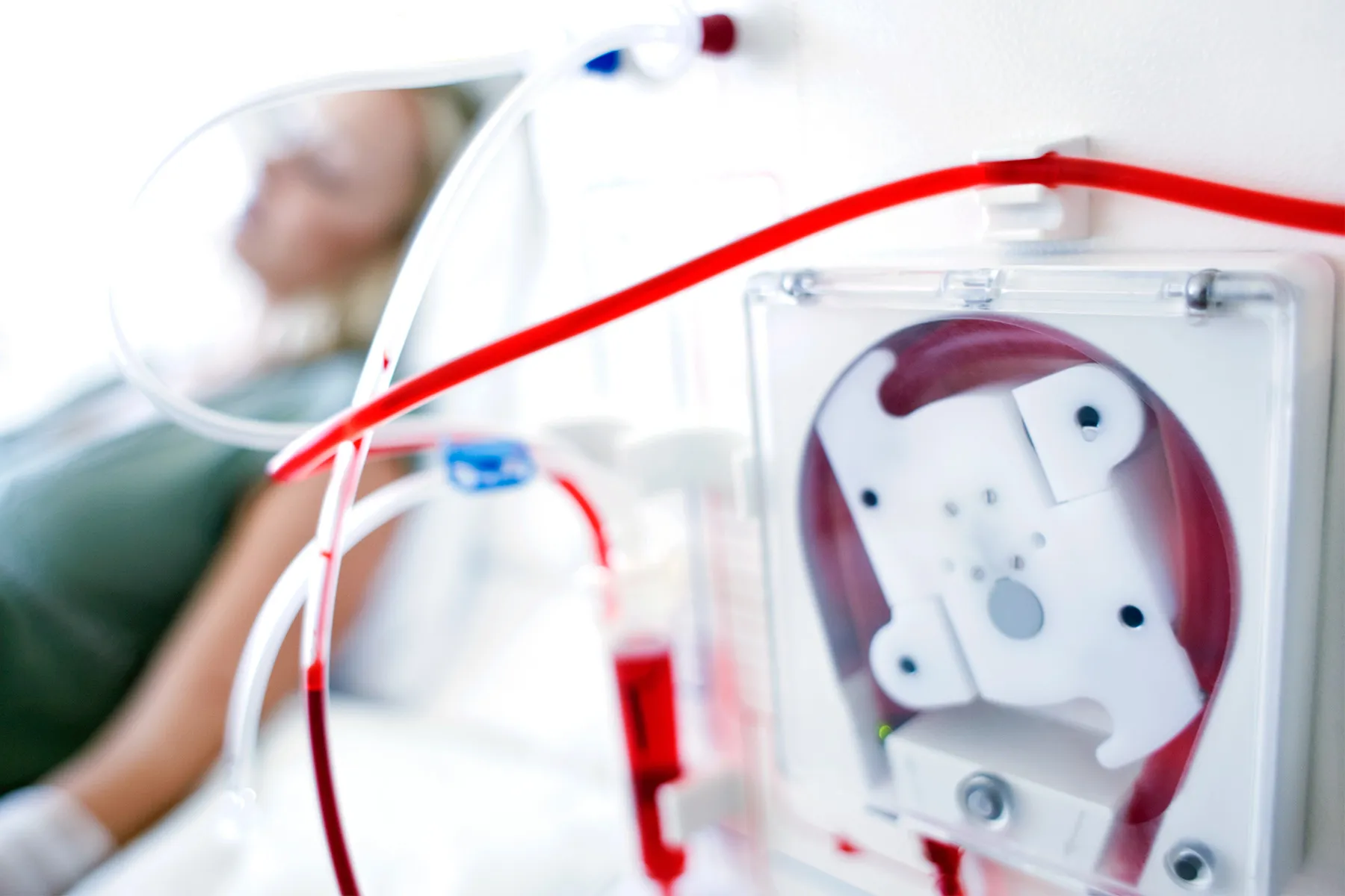 My Dialysis Device Performs as My Kidneys, for Now