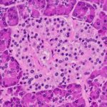 We Need to Greater Fully grasp Malnutrition-Linked Diabetes