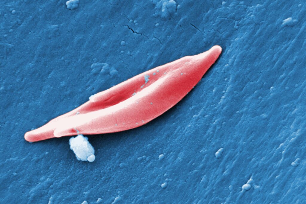 Fda Approves Very first CRISPR Gene Enhancing Treatment for Sickle Cell Condition