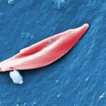 Fda Approves Very first CRISPR Gene Enhancing Treatment for Sickle Cell Condition