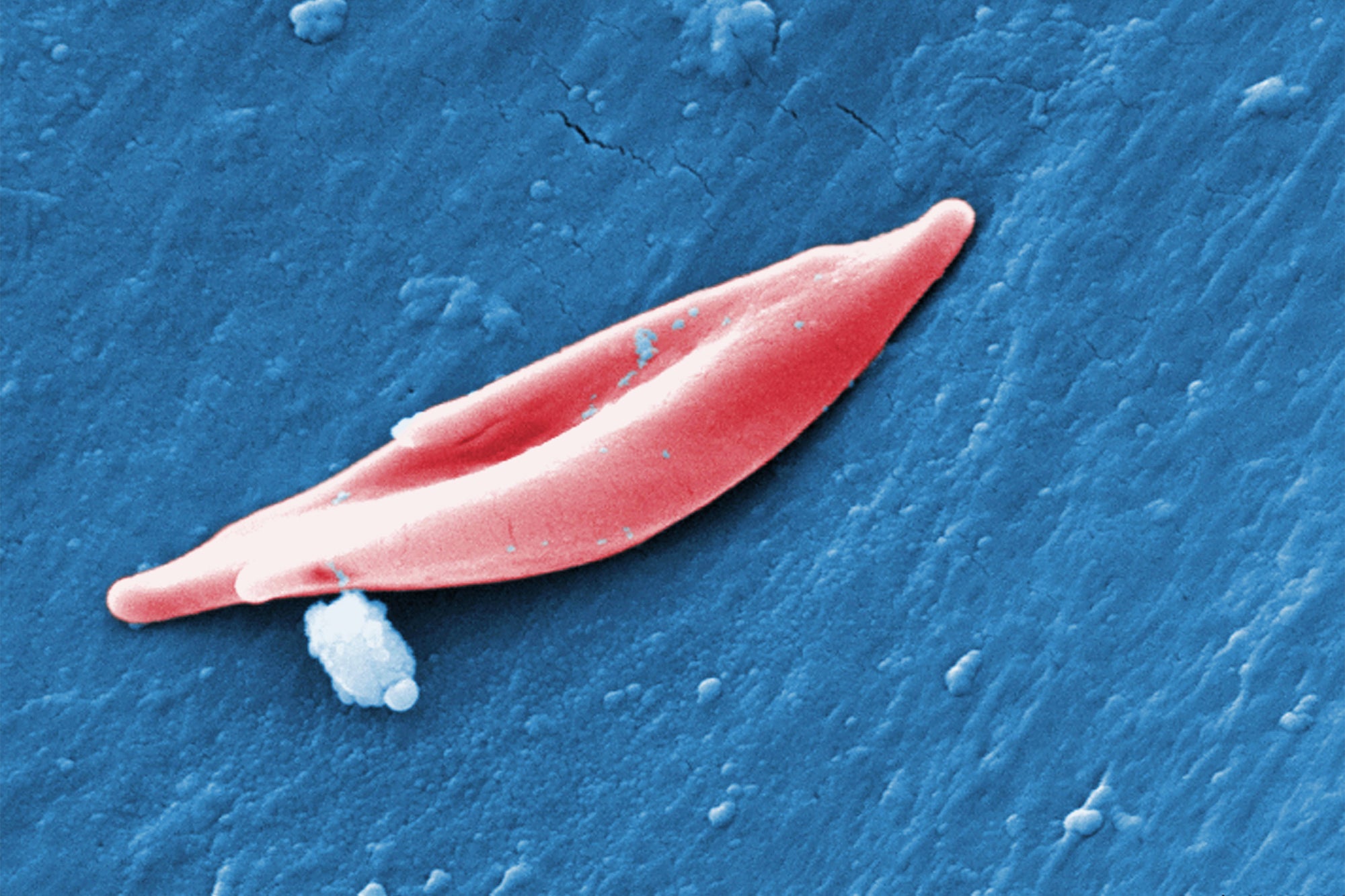 Fda Approves Very first CRISPR Gene Enhancing Treatment for Sickle Cell Condition
